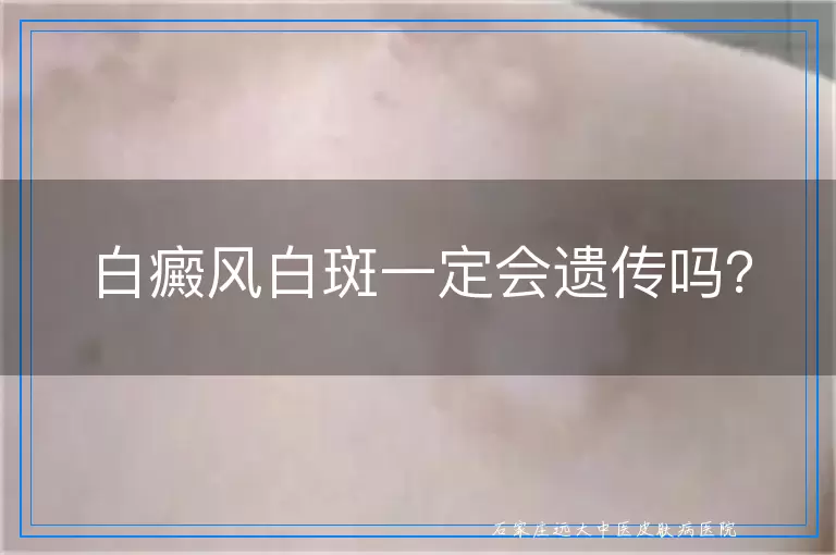 白癜风白斑一定会遗传吗？