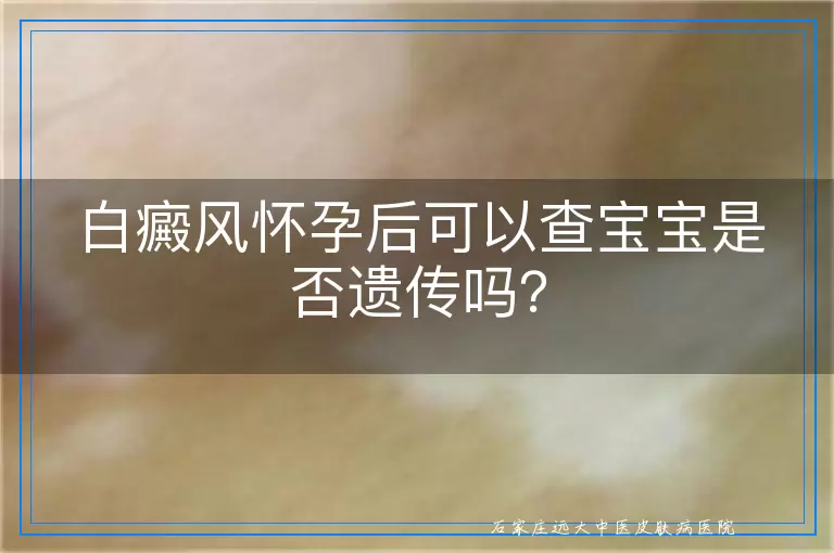 白癜风怀孕后可以查宝宝是否遗传吗？