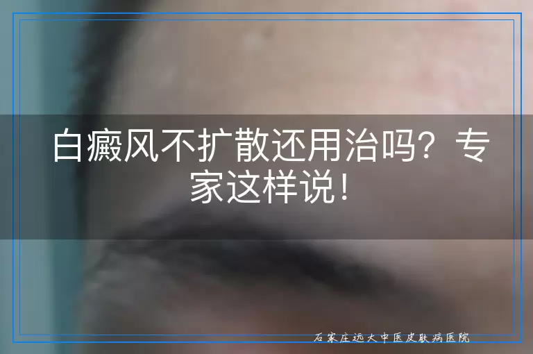白癜风不扩散还用治吗？专家这样说！