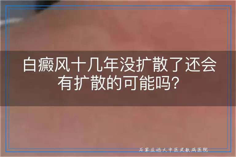 白癜风十几年没扩散了还会有扩散的可能吗？
