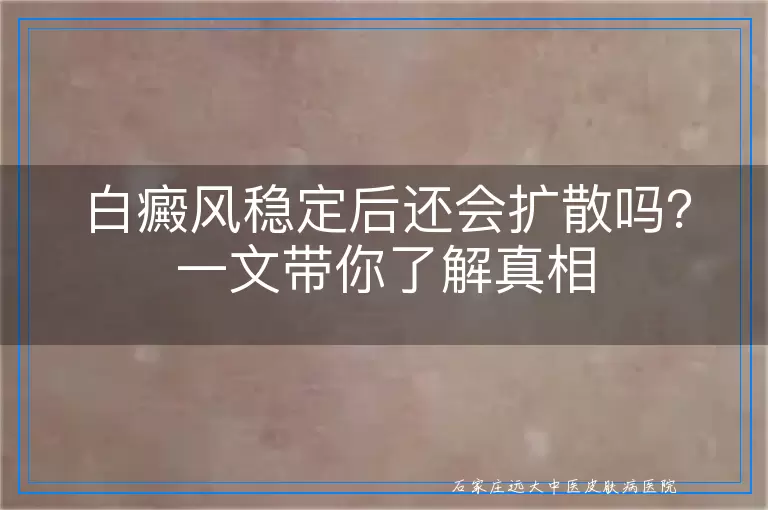 白癜风稳定后还会扩散吗？一文带你了解真相