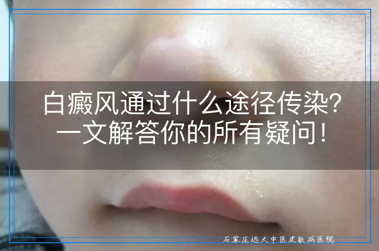 白癜风通过什么途径传染？一文解答你的所有疑问！