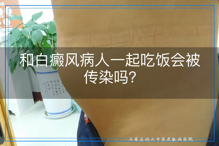 和白癜风病人一起吃饭会被传染吗？