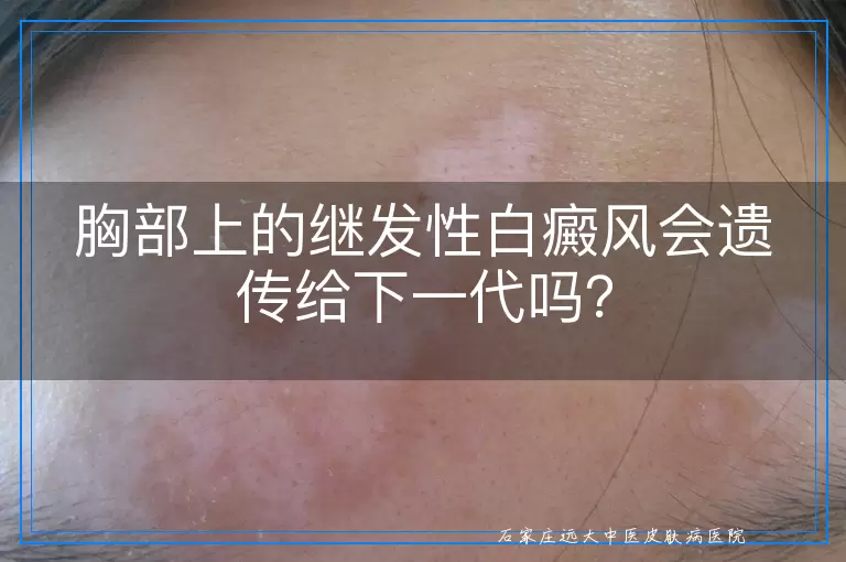 胸部上的继发性白癜风会遗传给下一代吗？
