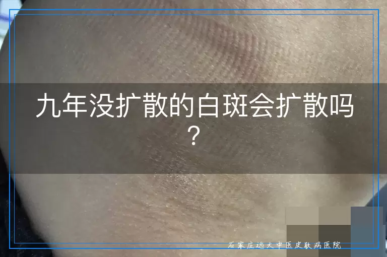 九年没扩散的白斑会扩散吗？
