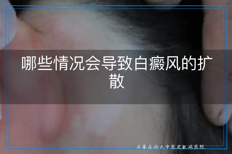 哪些情况会导致白癜风的扩散