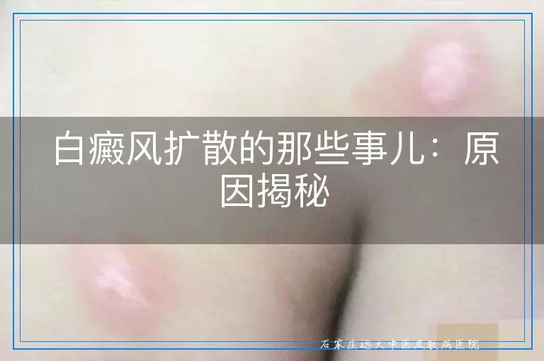 白癜风扩散的那些事儿：原因揭秘