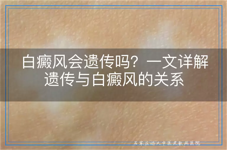 白癜风会遗传吗？一文详解遗传与白癜风的关系