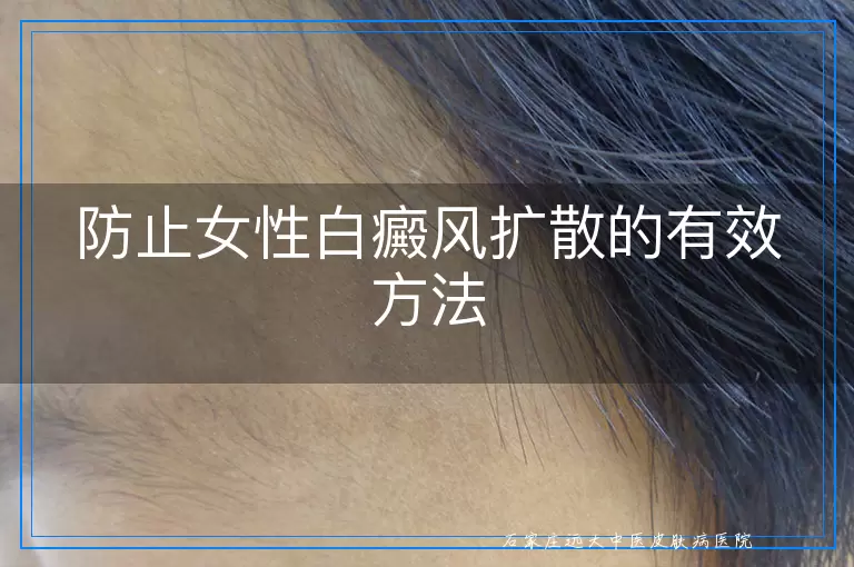防止女性白癜风扩散的有效方法