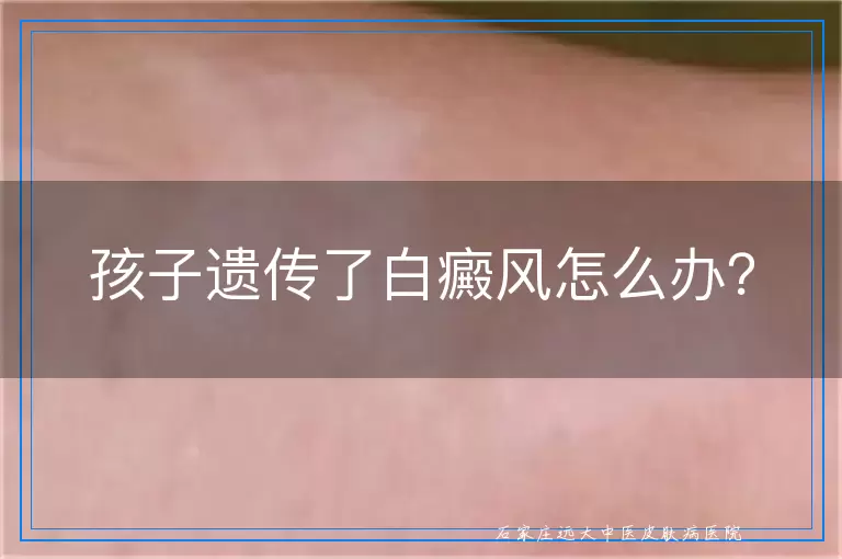 孩子遗传了白癜风怎么办？