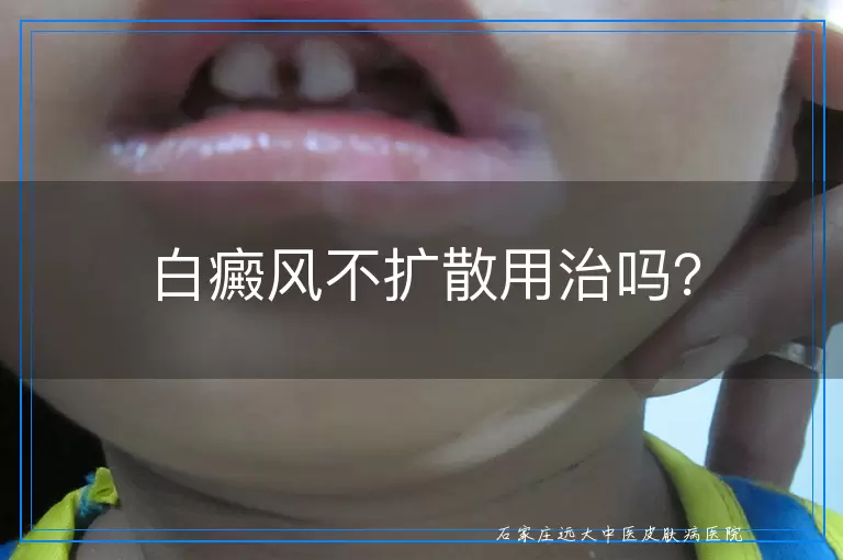 白癜风不扩散用治吗？