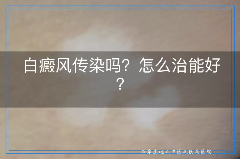 白癜风传染吗？怎么治能好？