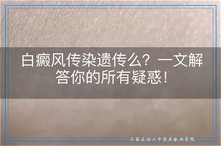 白癜风传染遗传么？一文解答你的所有疑惑！