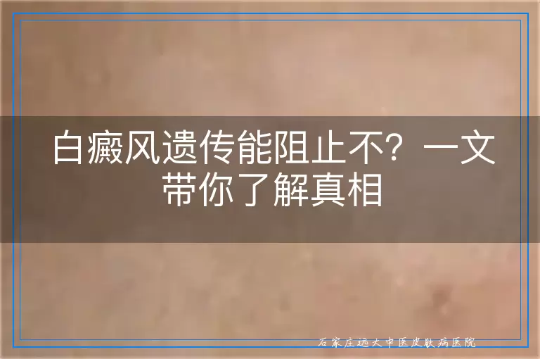 白癜风遗传能阻止不？一文带你了解真相