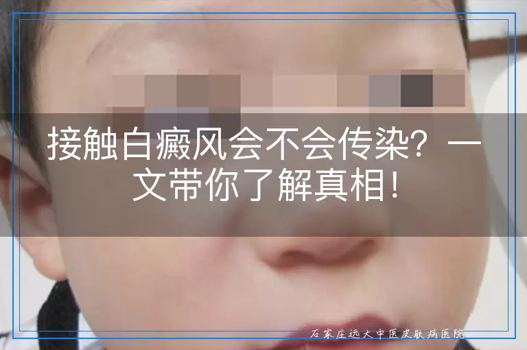 接触白癜风会不会传染？一文带你了解真相！
