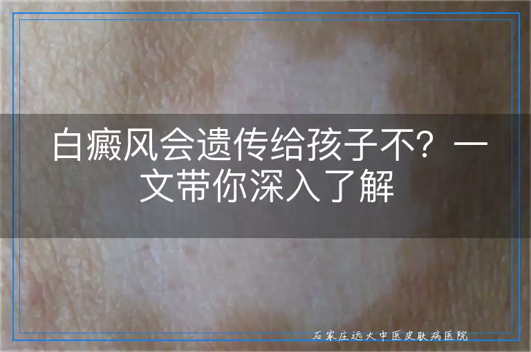 白癜风会遗传给孩子不？一文带你深入了解