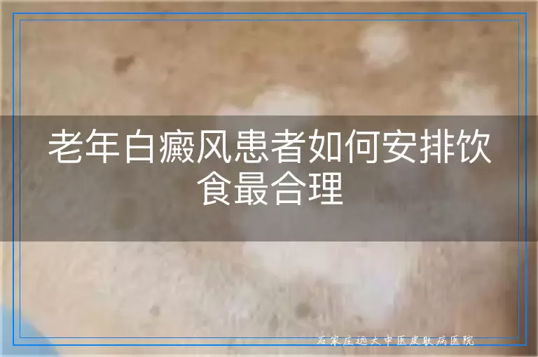 老年白癜风患者如何安排饮食最合理