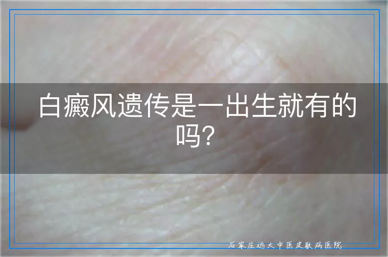白癜风遗传是一出生就有的吗？