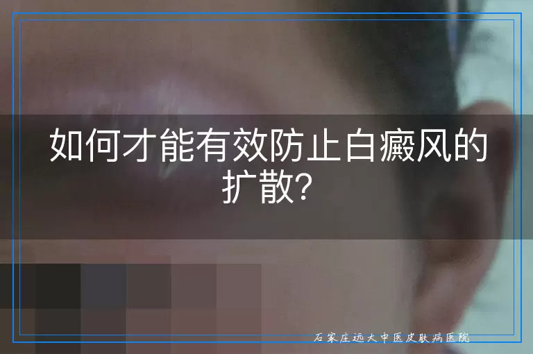 如何才能有效防止白癜风的扩散？