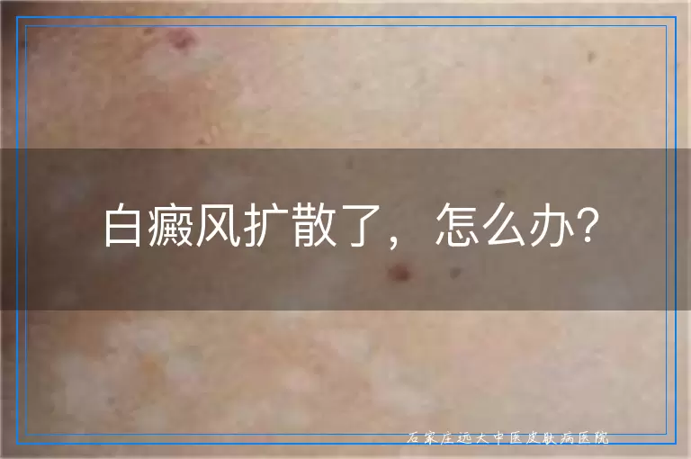白癜风扩散了，怎么办？