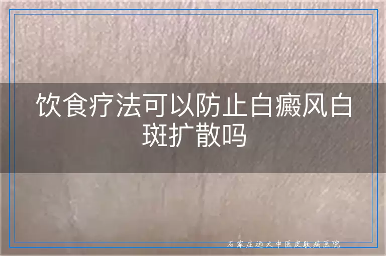 饮食疗法可以防止白癜风白斑扩散吗