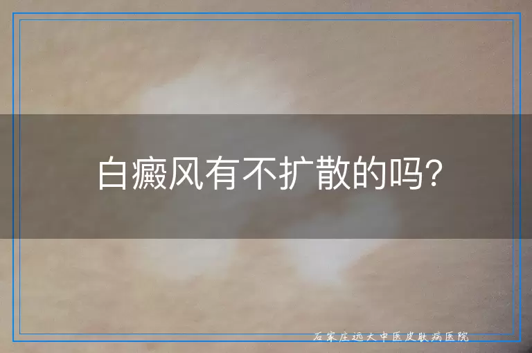 白癜风有不扩散的吗？