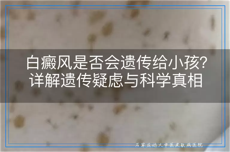 白癜风是否会遗传给小孩？详解遗传疑虑与科学真相