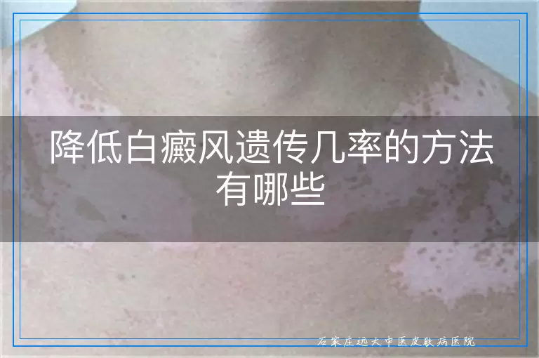 降低白癜风遗传几率的方法有哪些