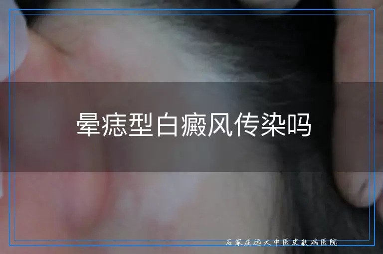 晕痣型白癜风传染吗