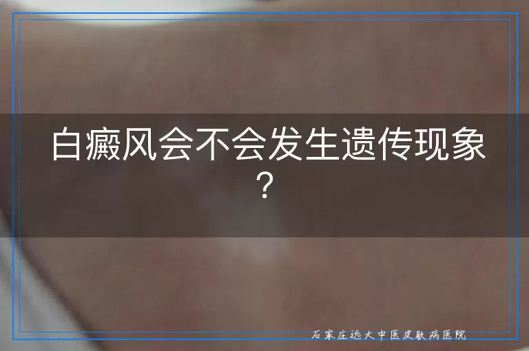 白癜风会不会发生遗传现象？