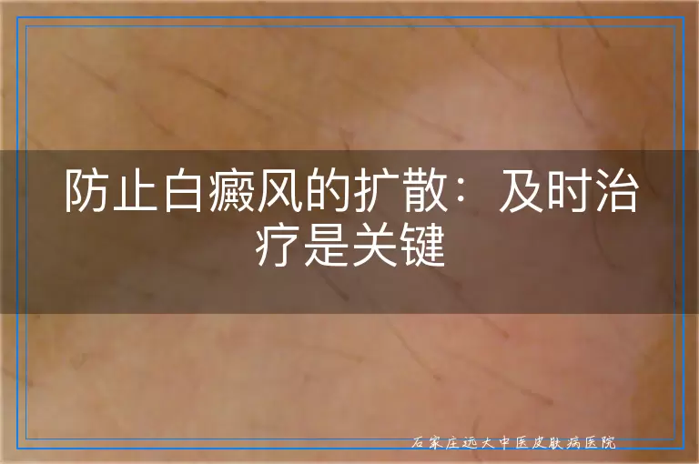 防止白癜风的扩散：及时治疗是关键