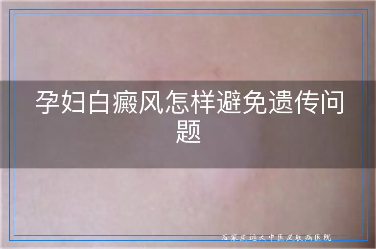 孕妇白癜风怎样避免遗传问题