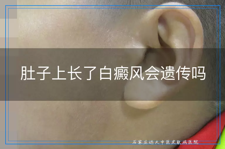 肚子上长了白癜风会遗传吗