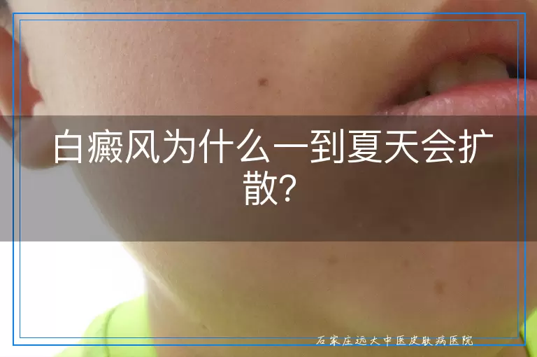 白癜风为什么一到夏天会扩散？