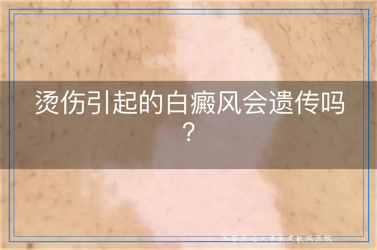 烫伤引起的白癜风会遗传吗？