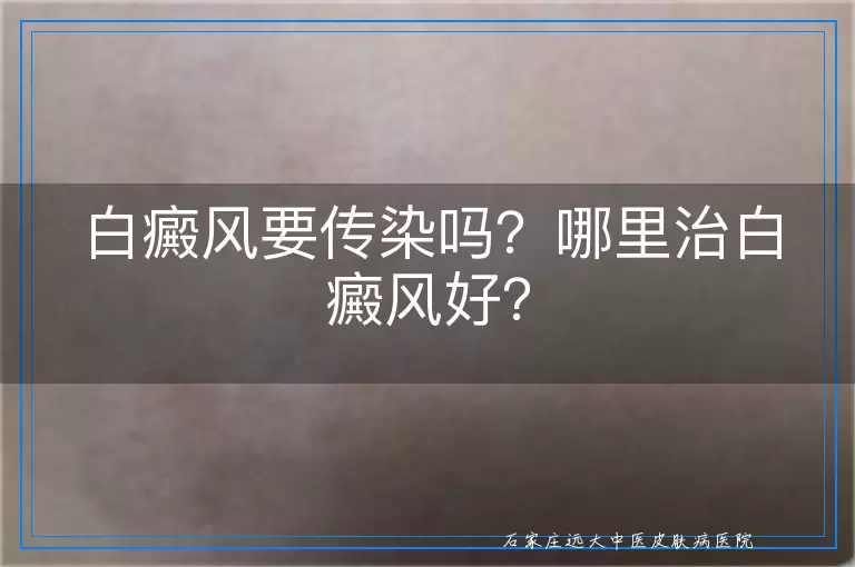 白癜风要传染吗？哪里治白癜风好？