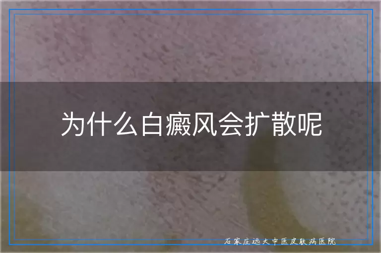 为什么白癜风会扩散呢