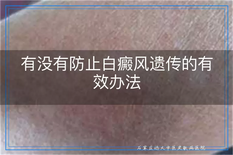 有没有防止白癜风遗传的有效办法