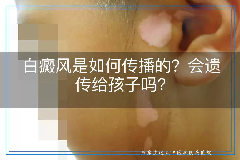 白癜风是如何传播的？会遗传给孩子吗？