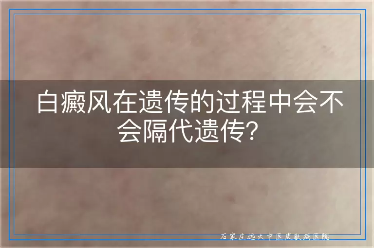 白癜风在遗传的过程中会不会隔代遗传？