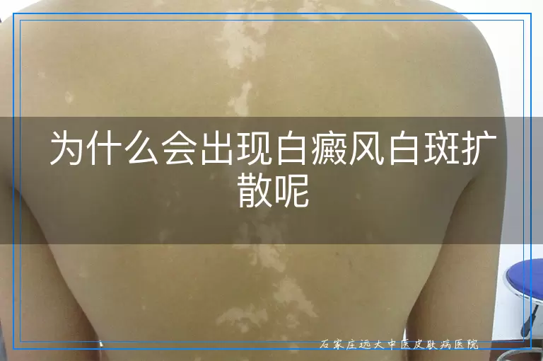 为什么会出现白癜风白斑扩散呢