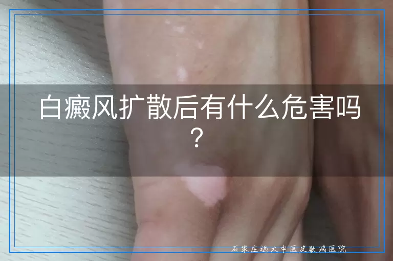 白癜风扩散后有什么危害吗？