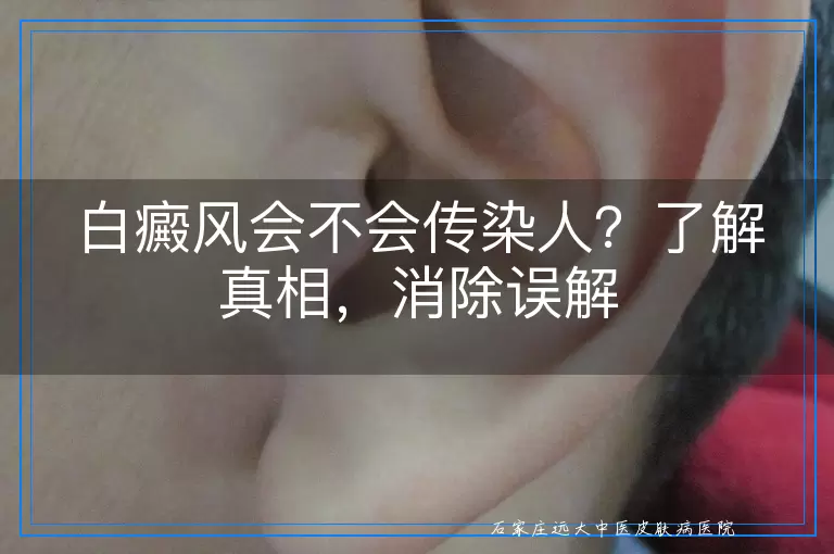 白癜风会不会传染人？了解真相，消除误解