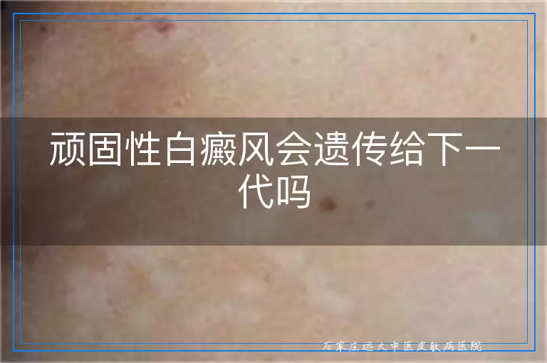 顽固性白癜风会遗传给下一代吗