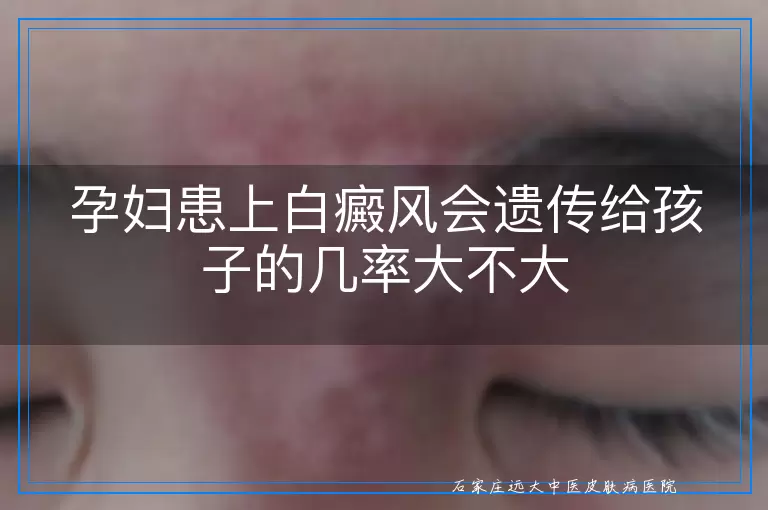 孕妇患上白癜风会遗传给孩子的几率大不大