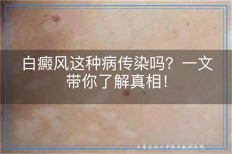 白癜风这种病传染吗？一文带你了解真相！