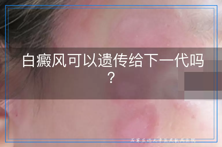 白癜风可以遗传给下一代吗？