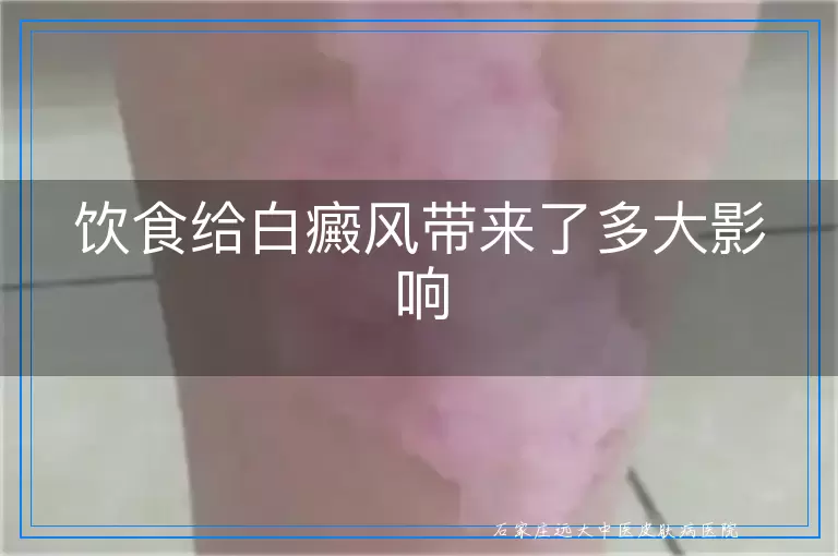 饮食给白癜风带来了多大影响