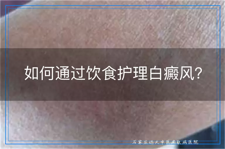 如何通过饮食护理白癜风？