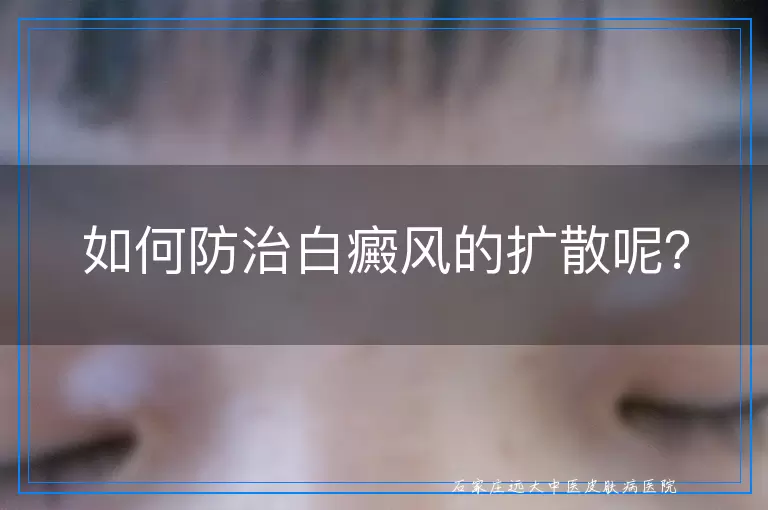 如何防治白癜风的扩散呢？